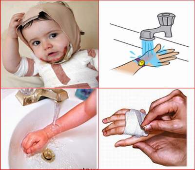 An toàn cho trẻ khi sơ cứu trẻ bị bỏng