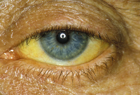 PRinc_rm_photo_of_jaundiced_eye.jpg