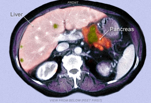 PRinc_rm_photo_scan_of_pancreatic_cancer.jpg